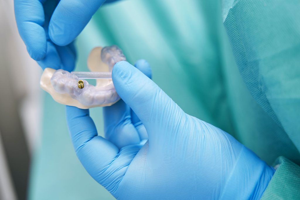 Co to jest szablon implantologiczny i jak może pomóc w leczeniu implantologicznym?